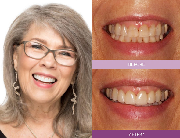 Angela-Veneers_edit