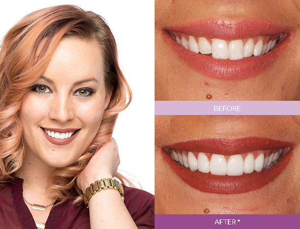 Angela_G-Veneers_edit