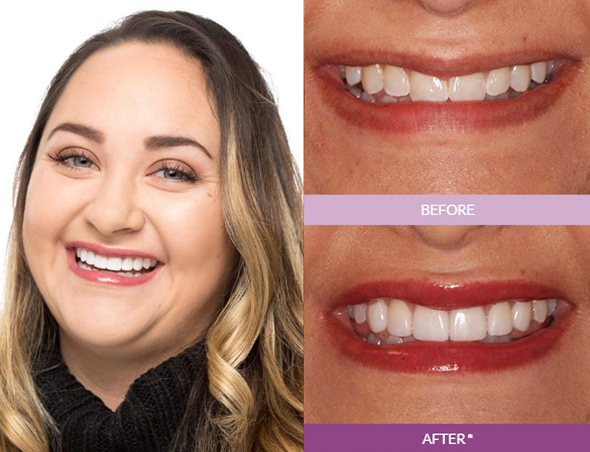 Katie_M-Veneers_edit