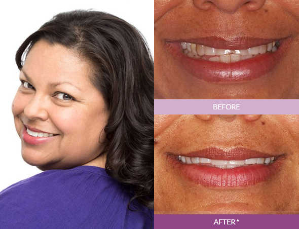 LuAnn_M-Veneers_edit