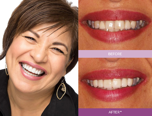 Marina_R-Veneers_edit