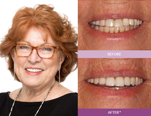 Micki-Dental-Crowns_edit