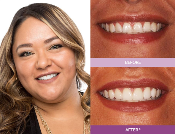 Nancy_M-Veneers_edit