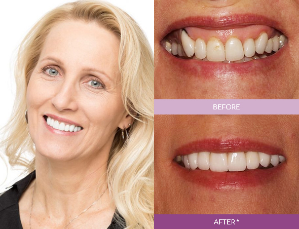 Veronica-Dental-Crowns-and-Veneers_edit