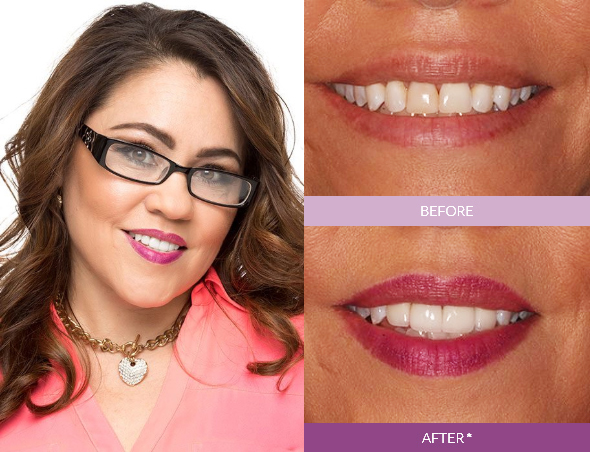 Veronica-P_Veneers_edit