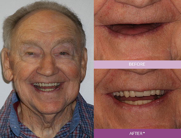 implantpatient-fullface