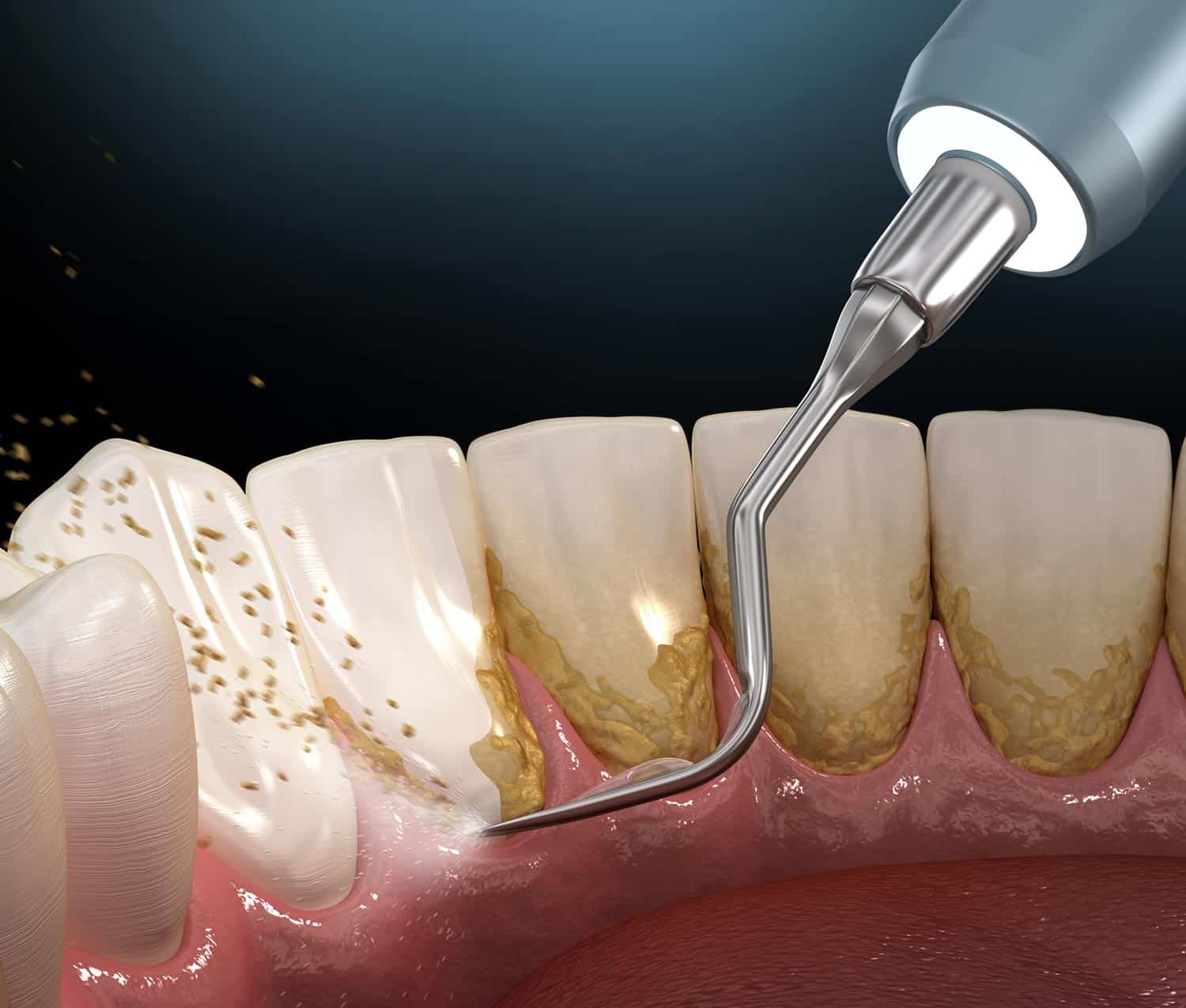 DEEP-CLEANING-GUMS