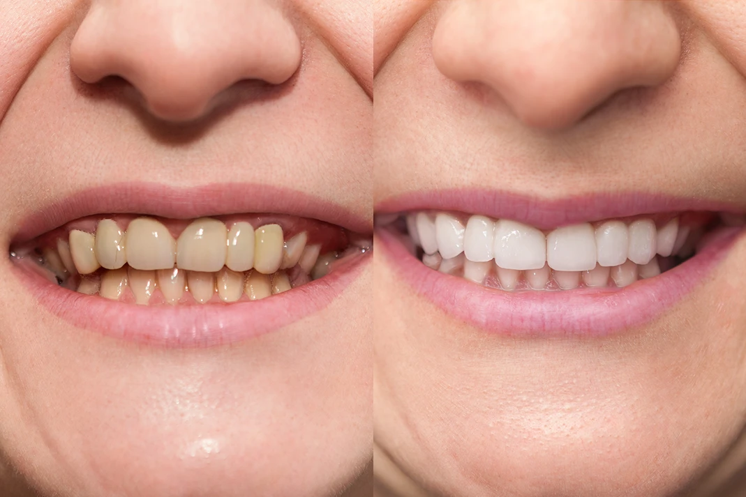 Why-Do-Teeth-Get-Stained