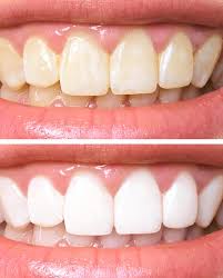 zoom whitening session