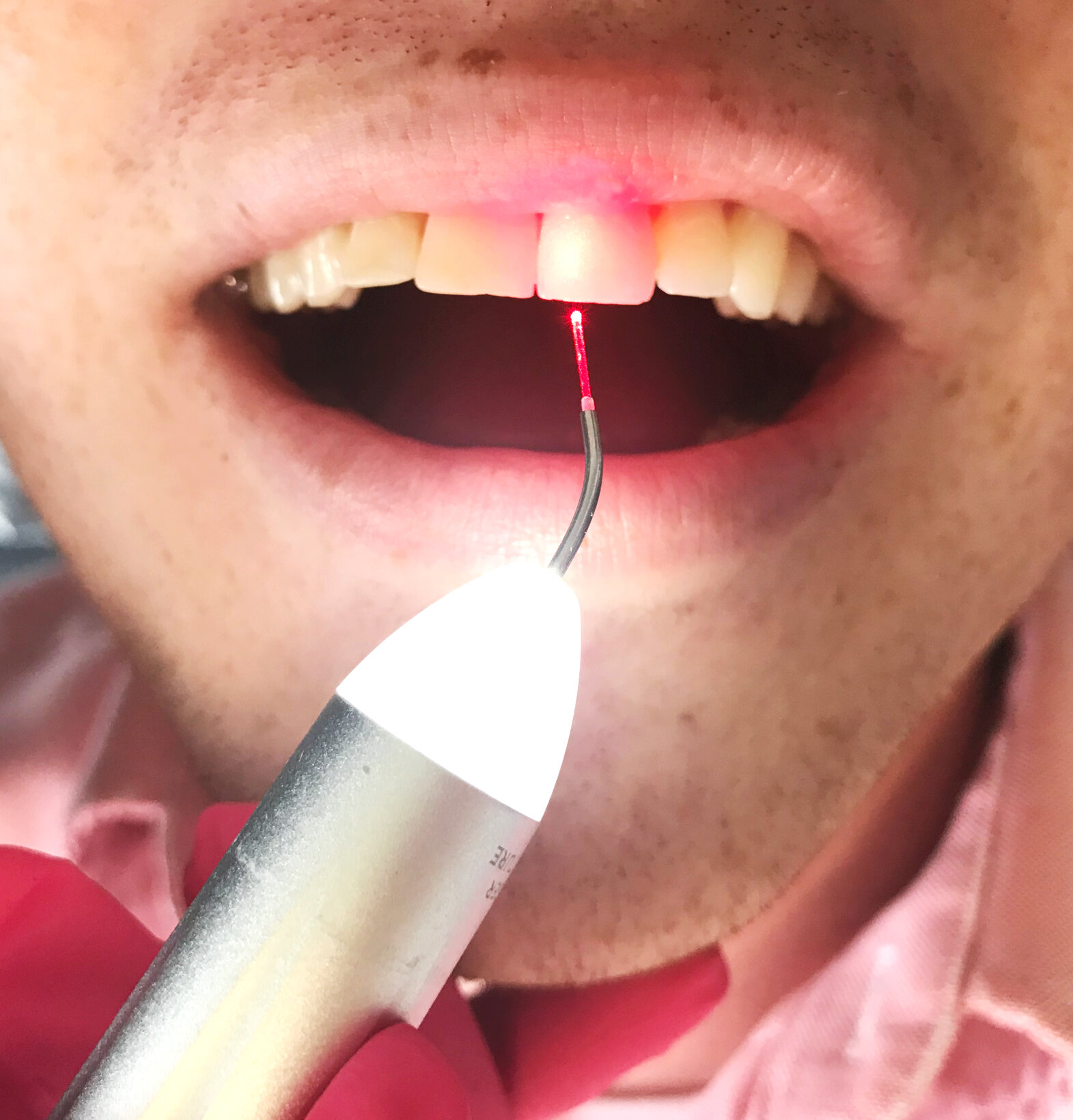 laser-gum-treatment-teeth-san-francisco