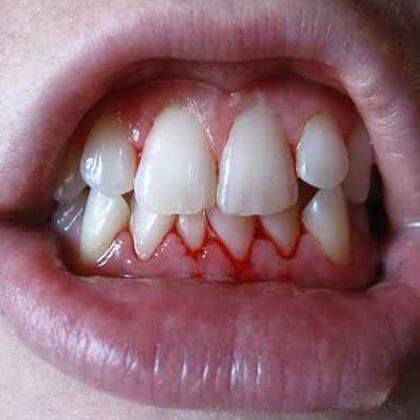 swollen-gums-how-to-stop-bleeding-gums