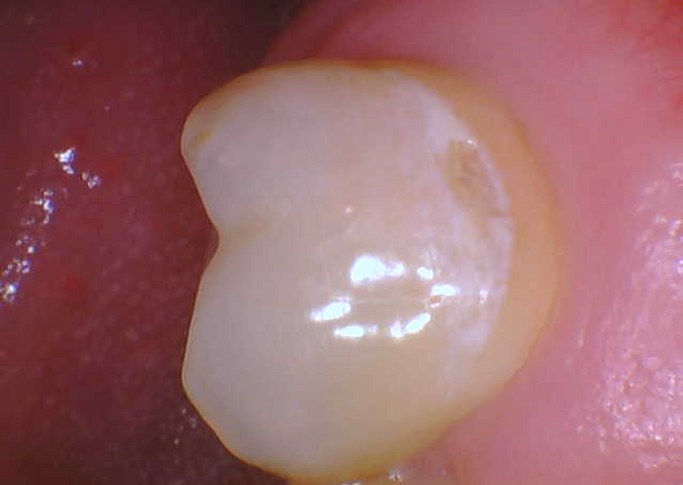 tooth in need of curodont