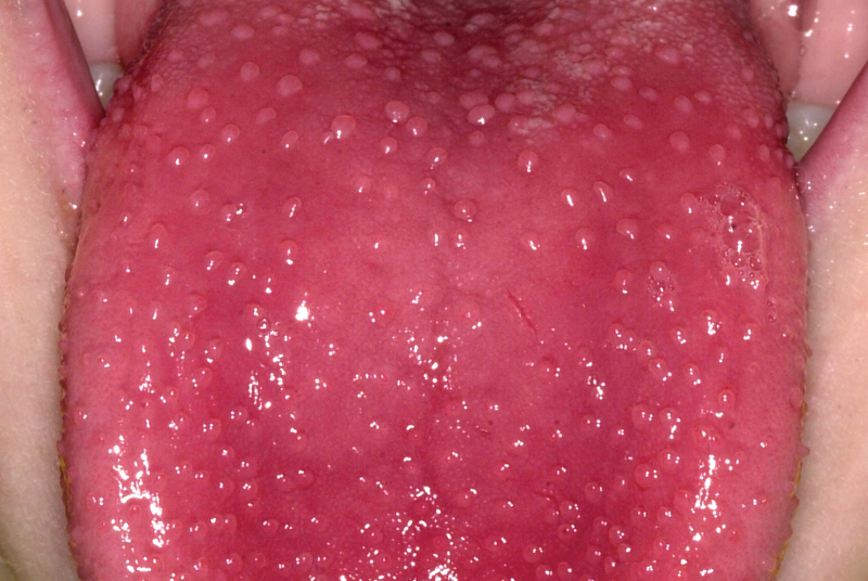 Strawberry-Tongue-20140313031106894