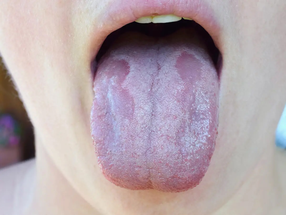 White patches tongue