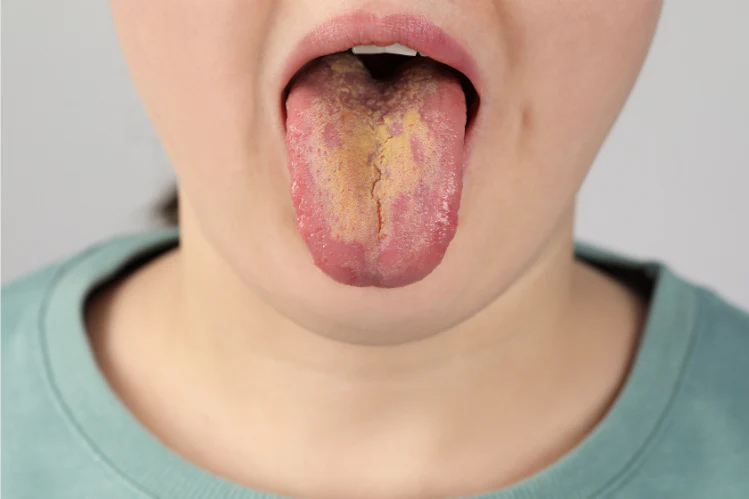 Yellow tongue