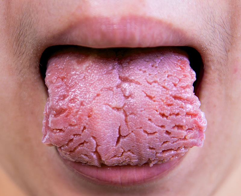 fissured-tongue