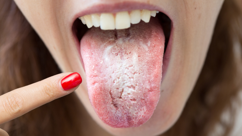 what-causes-white-tongue