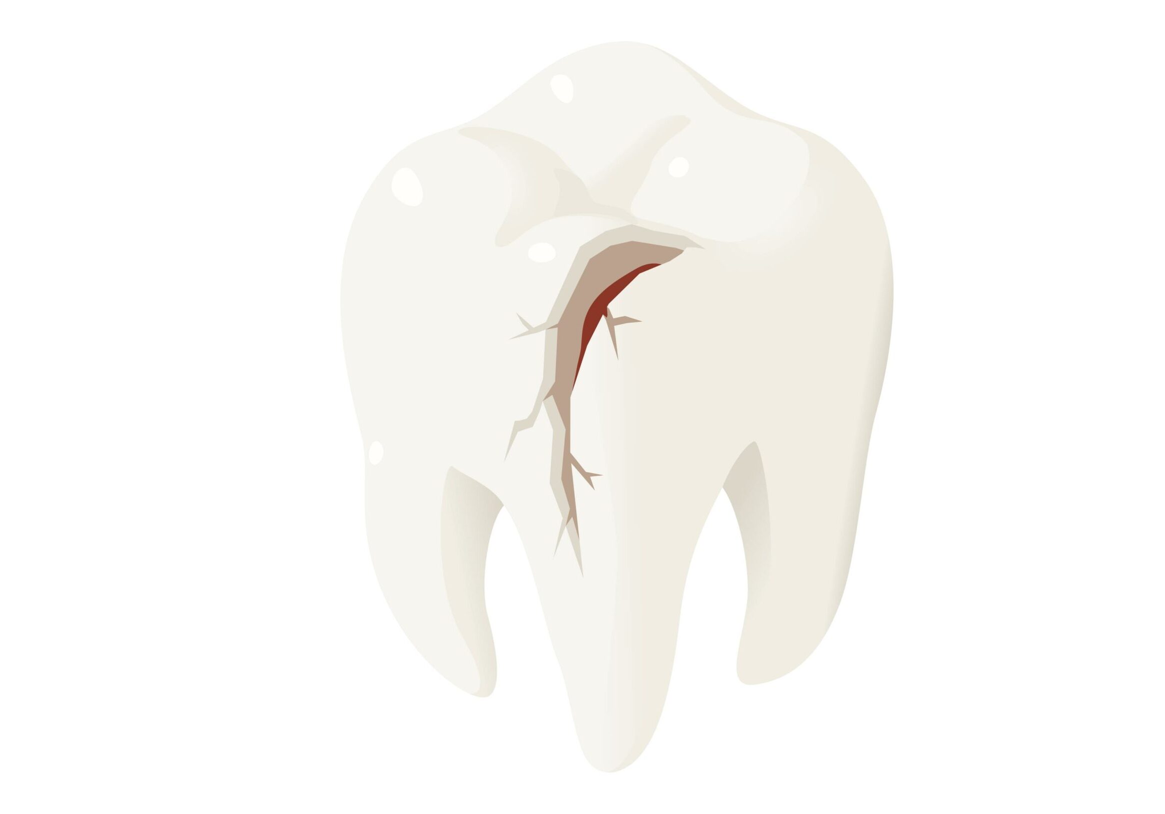 Chipped-or-broken-teeth​