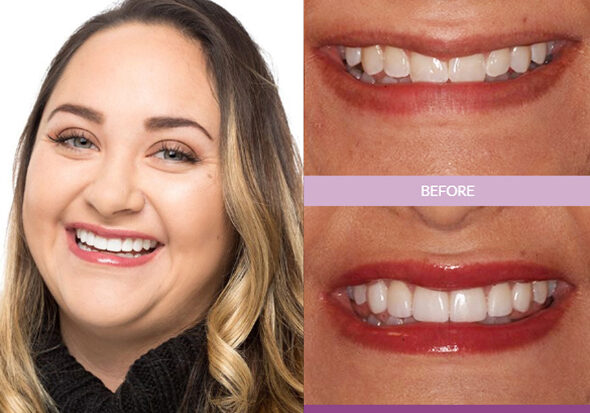 Katie_M-Veneers_edit
