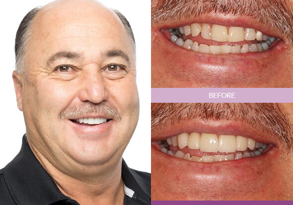 Pete-Dental-Crowns_edit