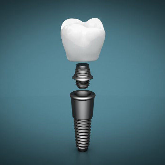 Tooth Extractions Image