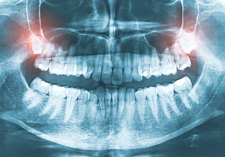 When-Are-Tooth-Extractions-Necessary​-1024x659