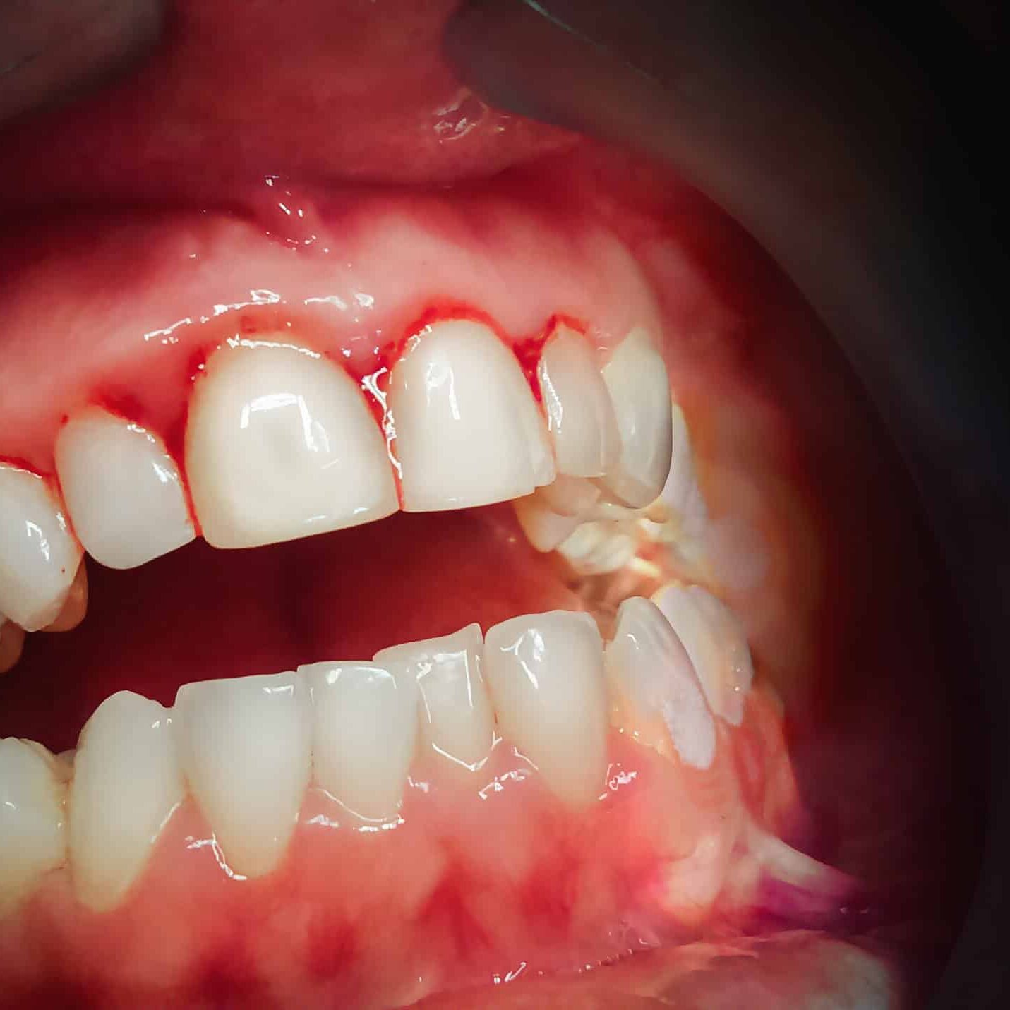 bleeding-gums-scaled