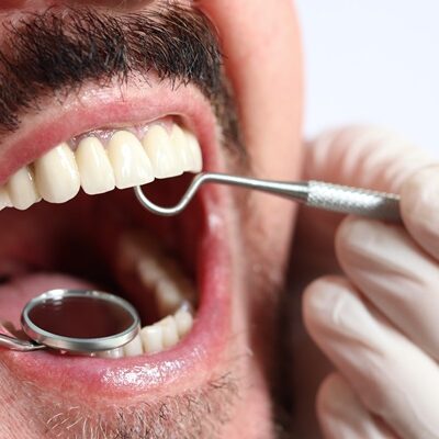 Close-up,Dental,Examination,Procedure.,Examination,Of,Dental,Crowns,Condition.,Oral
