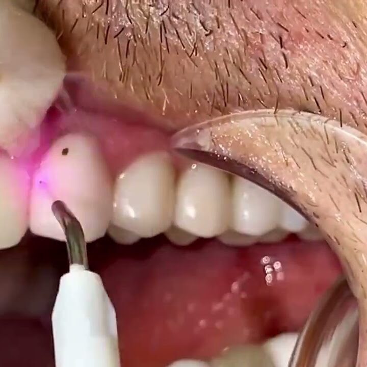 laser dentistry to help gum disease