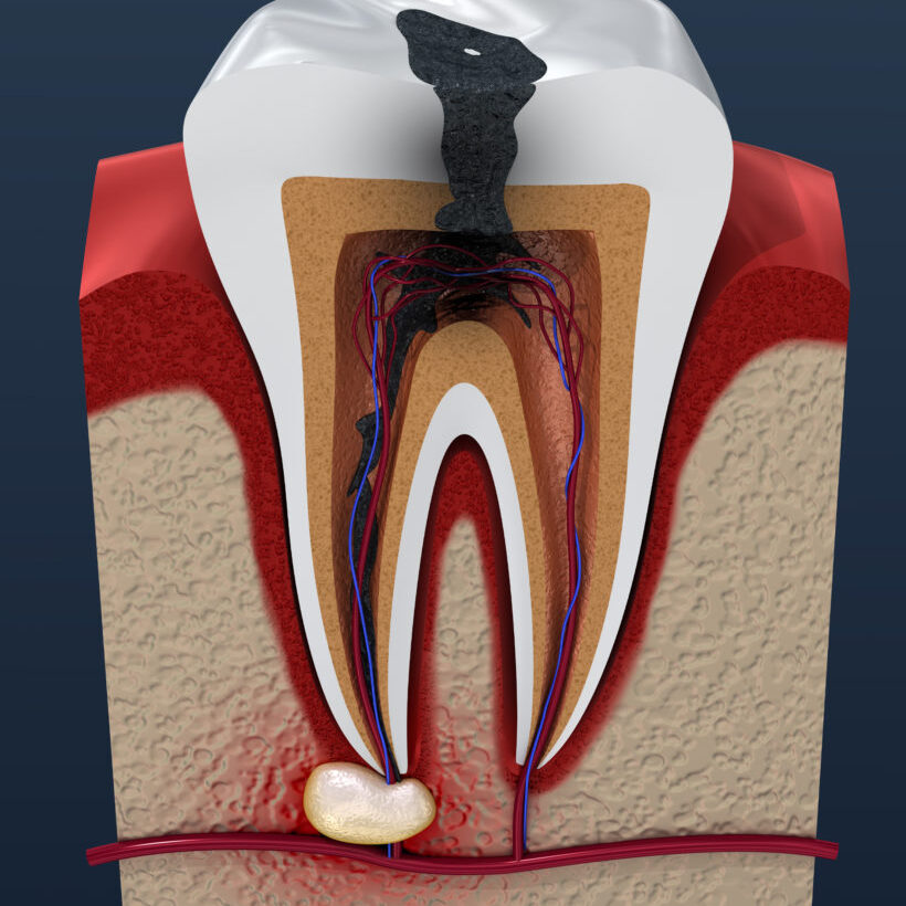 root-canal-820x1024